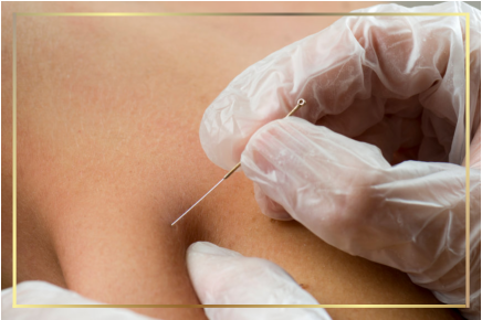 Dry needling for chronic shoulder, neck pain