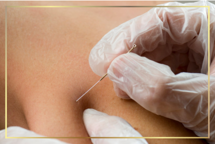 Dry needling for chronic shoulder, neck pain